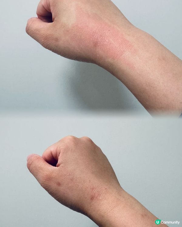 我既敏感皮膚救星 ❤️ WLP抗敏舒益生菌