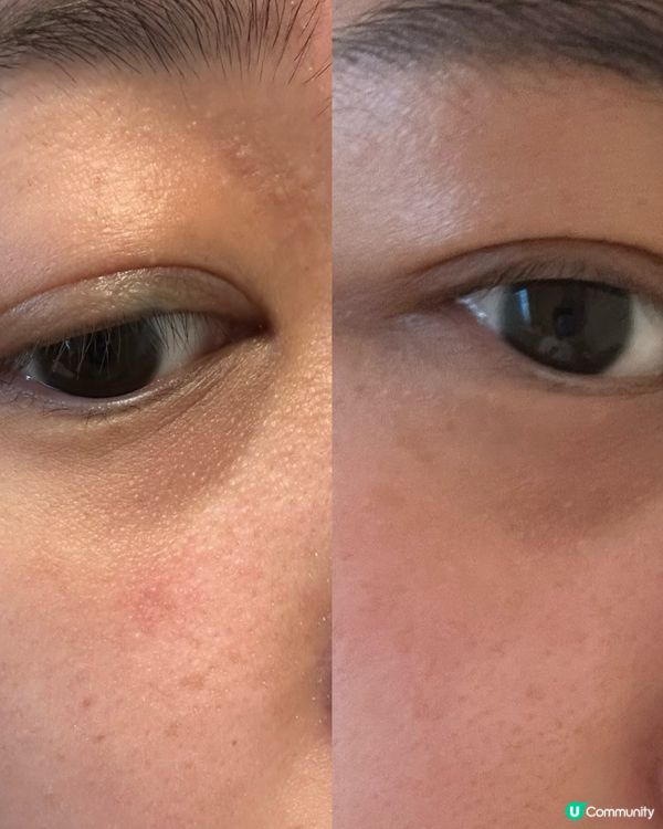 眼袋黑眼圈拜拜👋🏻  緊緻眼周✨  $488試做價