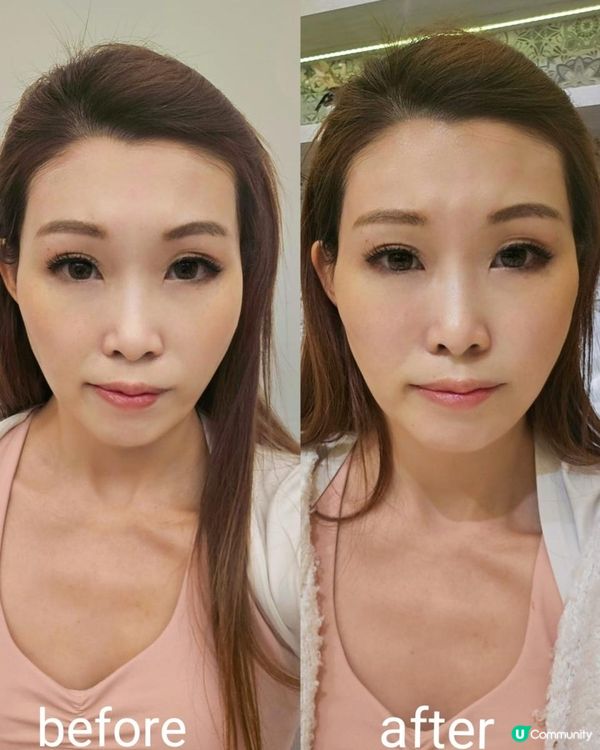 Juvelook素顏針流程+效果 0plus Clinic