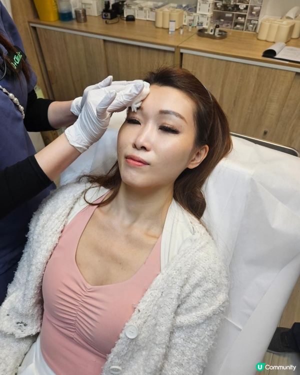 Juvelook素顏針流程+效果 0plus Clinic