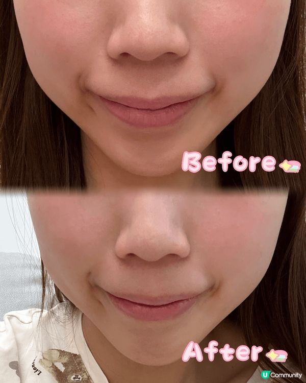 對我呢啲極度怕痛嘅人嚟講，一直都唔敢試醫美🙈。不過最近我發現...