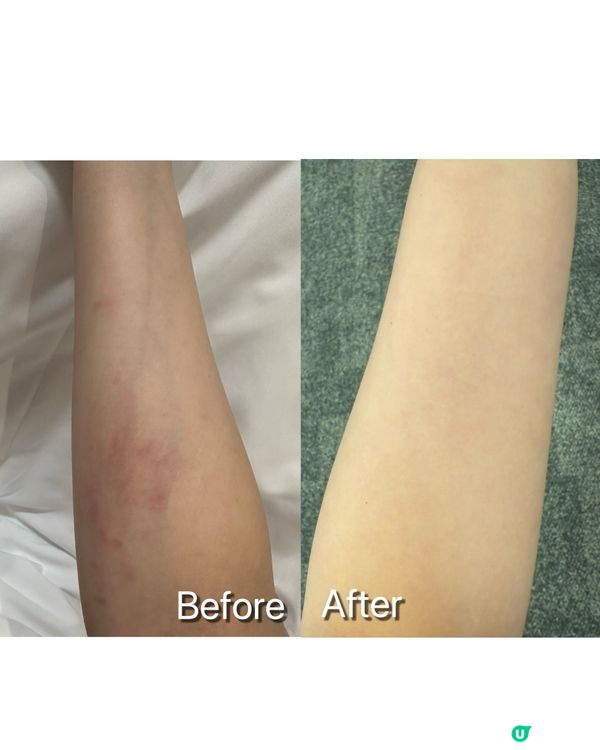 面紅腫敏感？😭  益生菌幫你💪