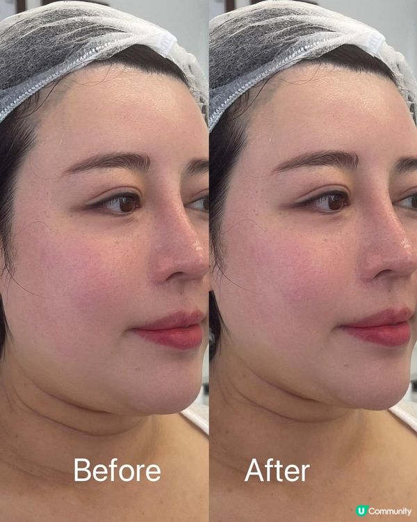 韓國🇰🇷整形界熱賣🌟CellIinew 矽谷拉提🌟