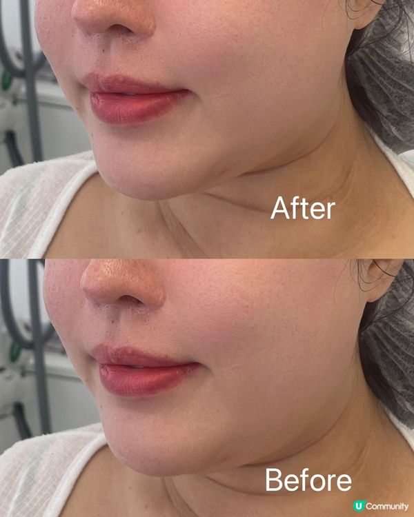 韓國🇰🇷整形界熱賣🌟CellIinew 矽谷拉提🌟