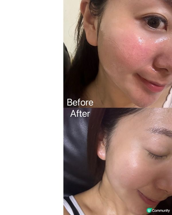 家用光療美容儀 改善泛紅/法令紋🤍 限時八折優惠‼️