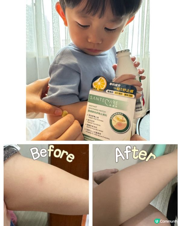 🙌🏻兒童止痕貼 快速見效 