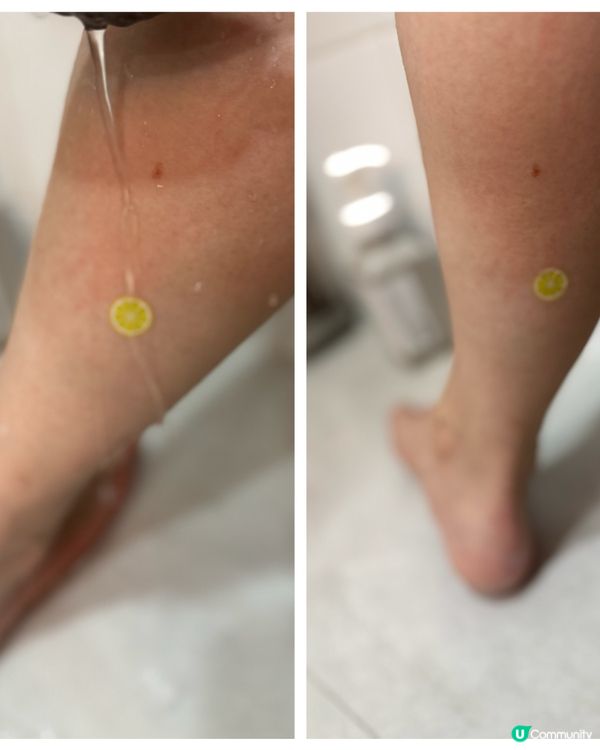 🙌🏻兒童止痕貼 快速見效 