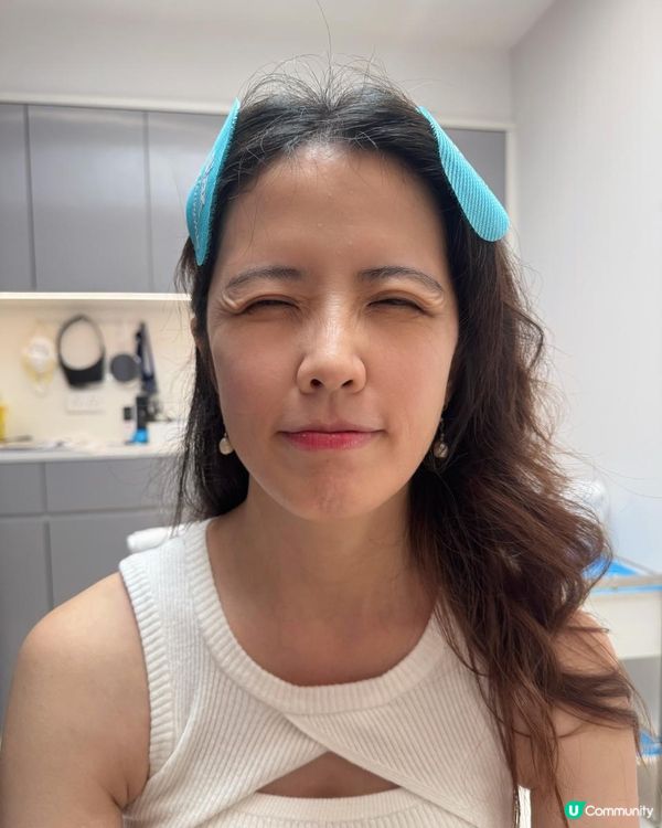 韓國Siax肉毒實測，10分鐘擺脫皺紋+下顎線鈍重