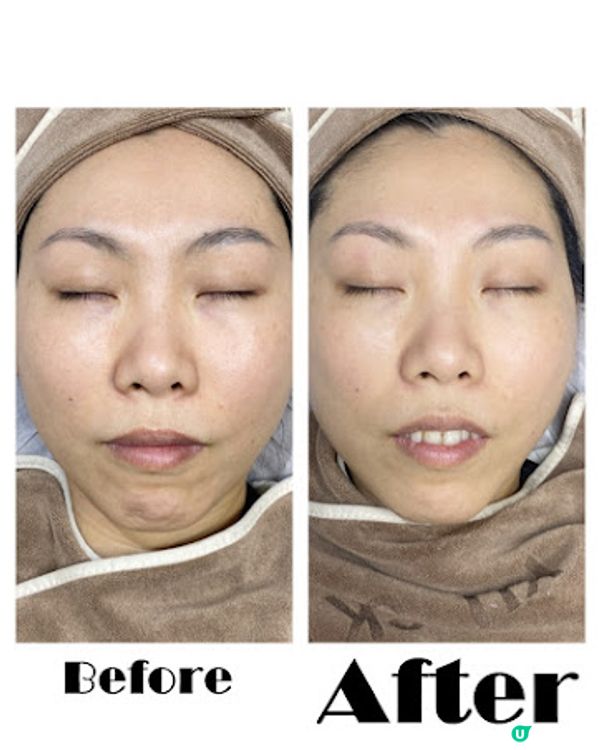 一次變白真係得？ Ku Skin BBI嫩白療程好唔好！？