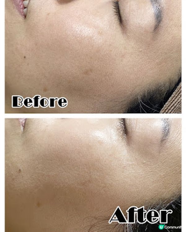 一次變白真係得？ Ku Skin BBI嫩白療程好唔好！？