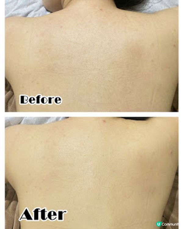 一次變白真係得？ Ku Skin BBI嫩白療程好唔好！？