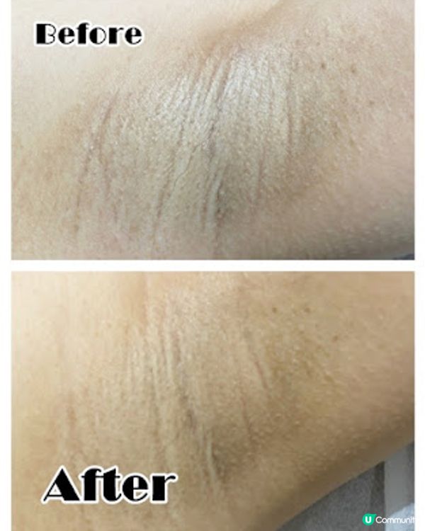 一次變白真係得？ Ku Skin BBI嫩白療程好唔好！？