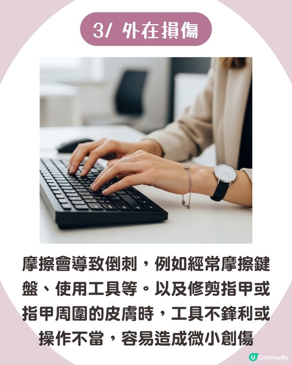 強行撕倒刺或致發炎‼ 正確去倒刺步驟+ 6大護手貼士