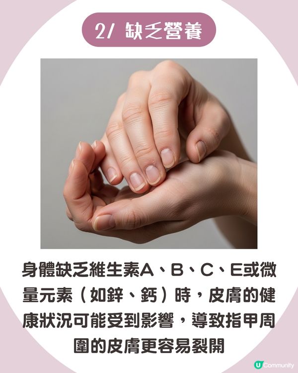 強行撕倒刺或致發炎‼ 正確去倒刺步驟+ 6大護手貼士