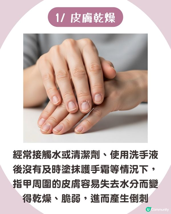 強行撕倒刺或致發炎‼ 正確去倒刺步驟+ 6大護手貼士