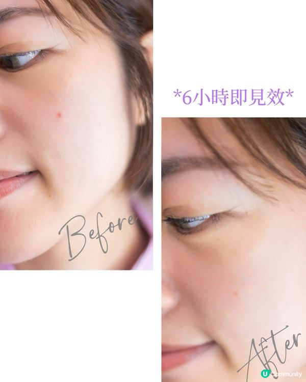 𝐁𝐞𝐧𝐳𝐚𝐜💜｜6小時去痘法👧🏻 