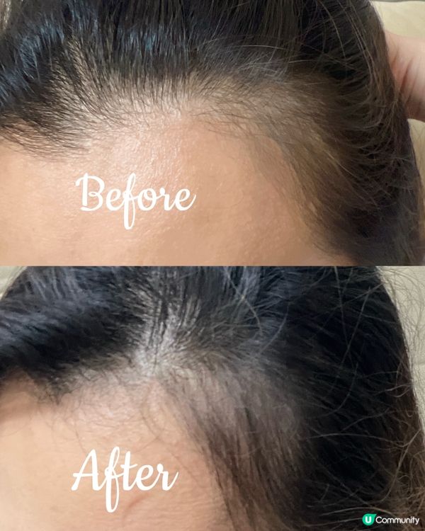 脫髮救星🌟1個月見效·限時8折