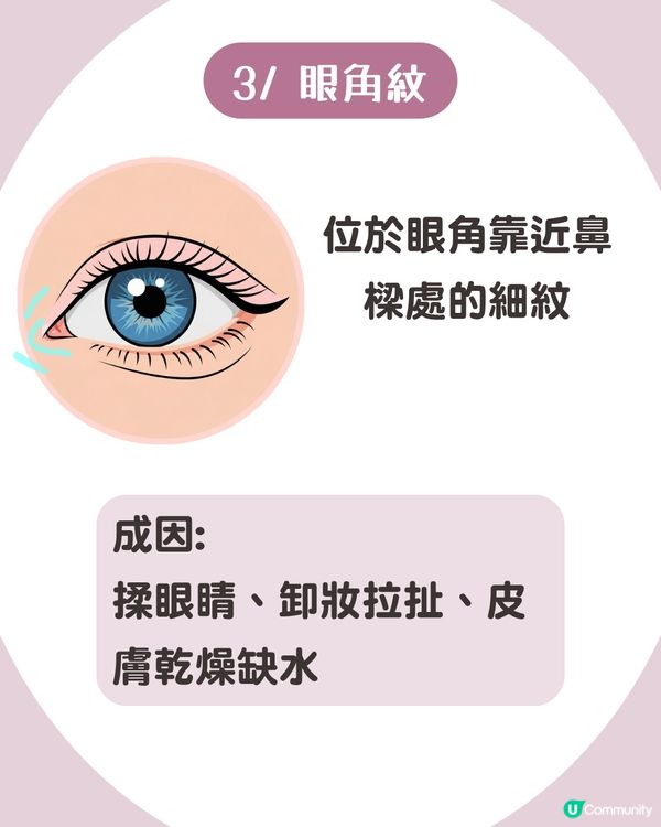 告別眼紋！6大類型深度解析 5大成因/預防策略👁️魚尾紋/細紋有得救！