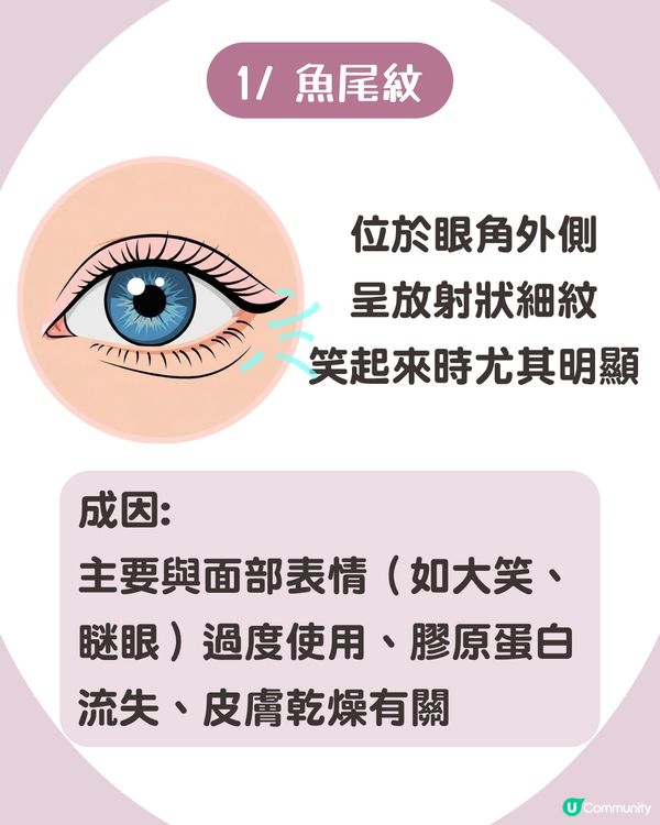 告別眼紋！6大類型深度解析 5大成因/預防策略👁️魚尾紋/細紋有得救！