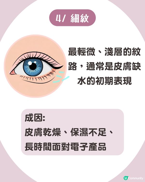 告別眼紋！6大類型深度解析 5大成因/預防策略👁️魚尾紋/細紋有得救！
