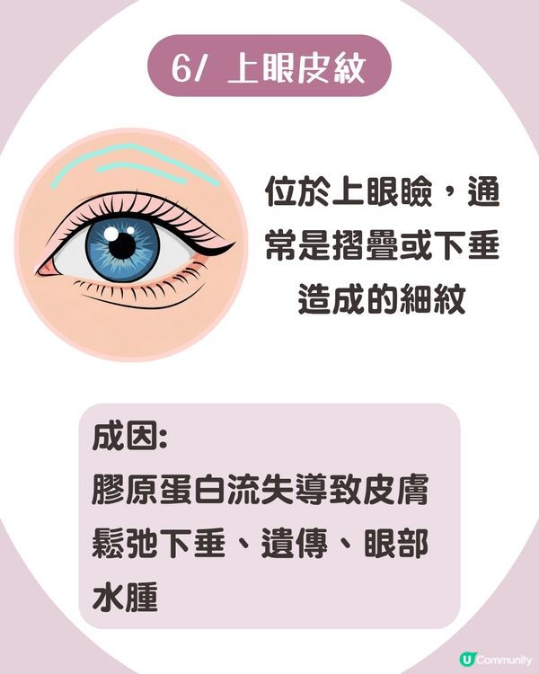 告別眼紋！6大類型深度解析 5大成因/預防策略👁️魚尾紋/細紋有得救！