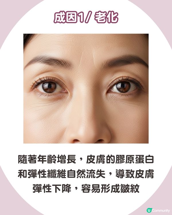 告別眼紋！6大類型深度解析 5大成因/預防策略👁️魚尾紋/細紋有得救！