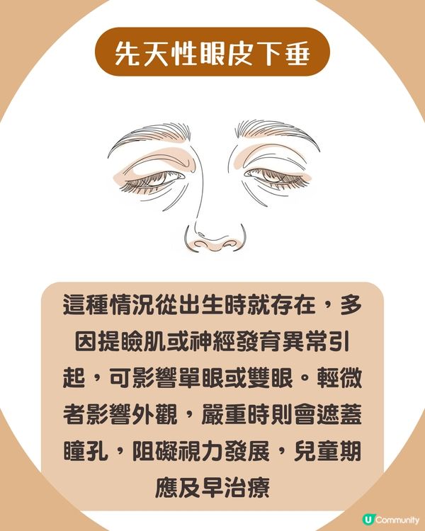 告別疲態！眼皮下垂5大原因解析+7招改善眼周肌膚鬆弛