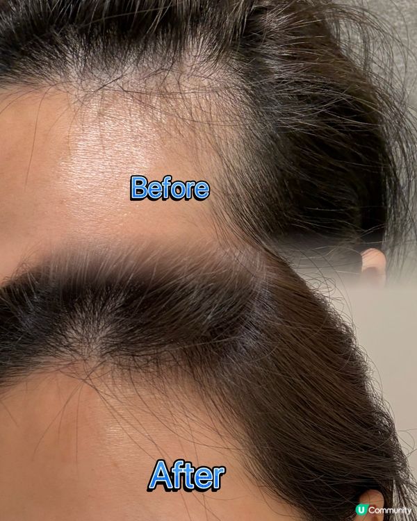 1.  甩髮救星！1個月激生髮💥 告別地中海！👴🏻➡️👦🏻