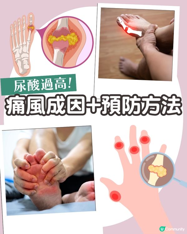 痛風全攻略：了解尿酸過高根源💢 5大痛風成因、症狀與預防