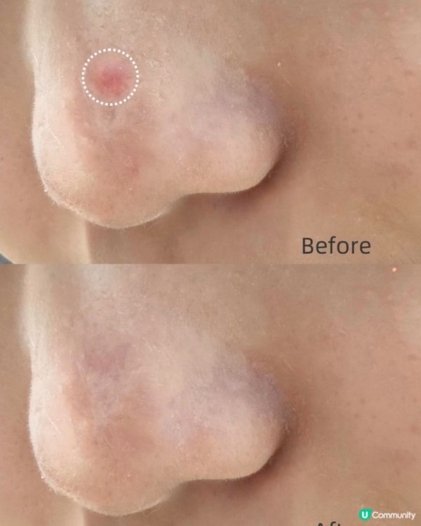 重要日子爆痘？救星嚟啦！🤩 3重功效痘痘貼7折！🔥