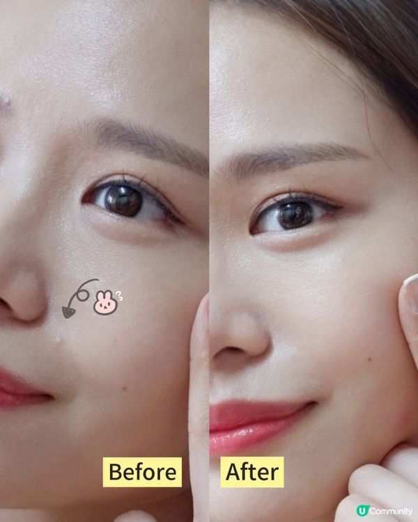 【暗瘡翻發？醫生推薦神器！🤩】