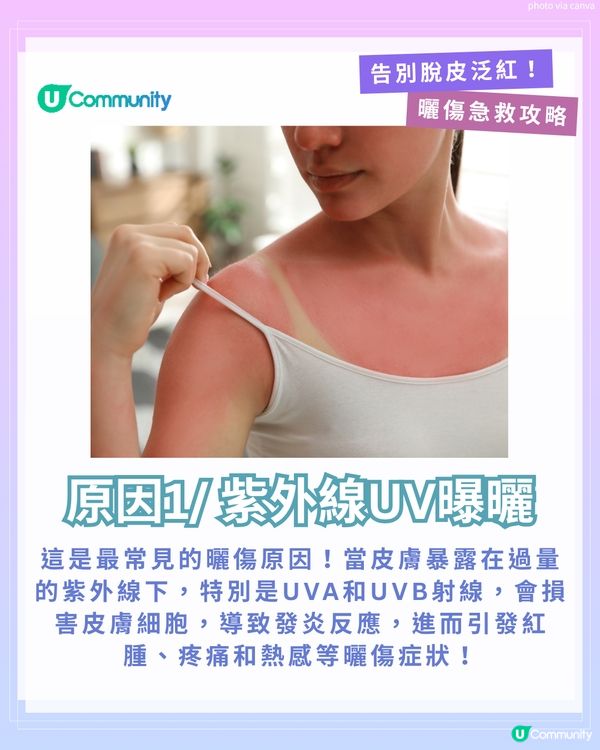 曬傷點算?☀️ 6大後續處理方法+禁做4件事！ 教你告別脫皮泛紅！