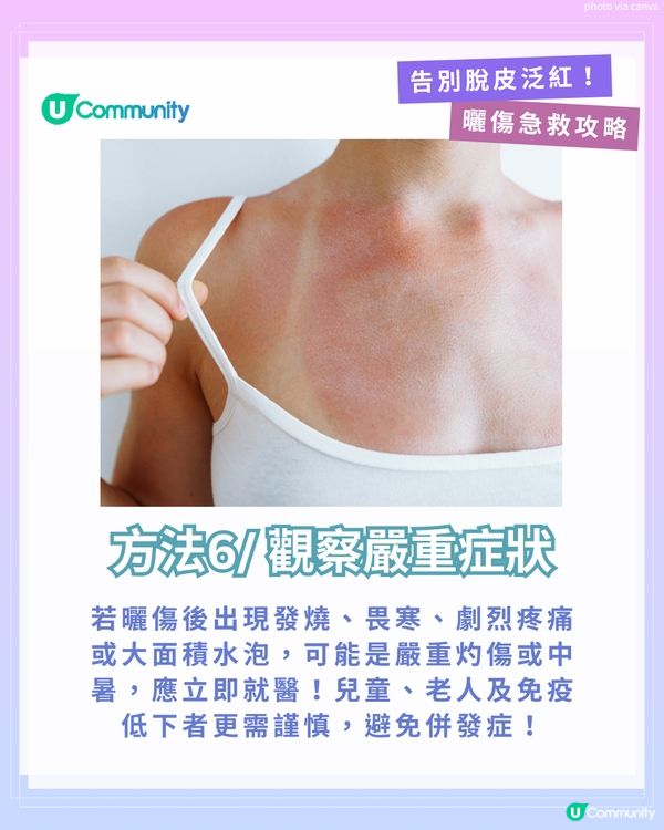 曬傷點算?☀️ 6大後續處理方法+禁做4件事！ 教你告別脫皮泛紅！