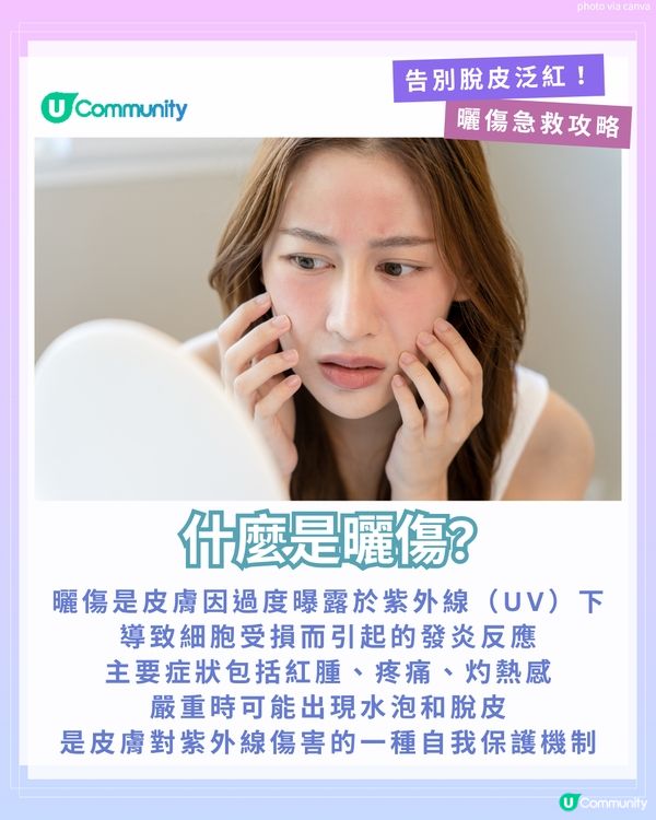 曬傷點算?☀️ 6大後續處理方法+禁做4件事！ 教你告別脫皮泛紅！