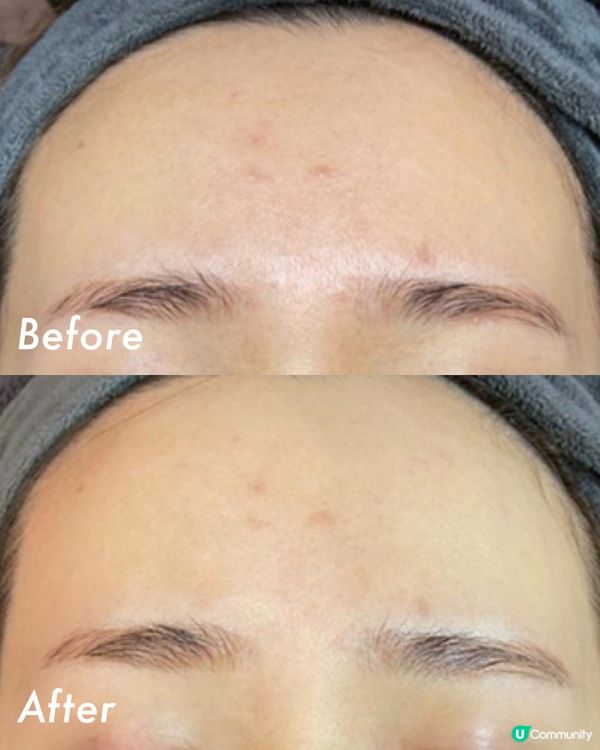 暗瘡生完又生😩?Benzac AC Gel 徹底擊退痘痘!​