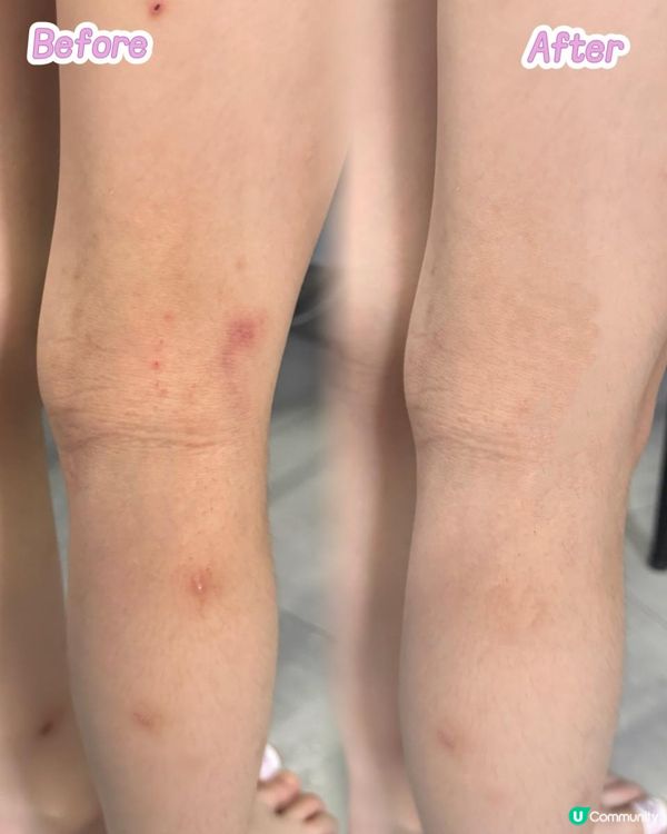 10天拯救濕疹+曬後脫皮🌸