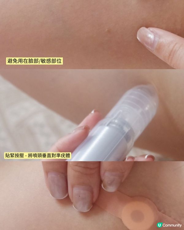 「手腳上的皮膚長起凹凹凸凸的肉粒？有可能是傳染性高的疣！」