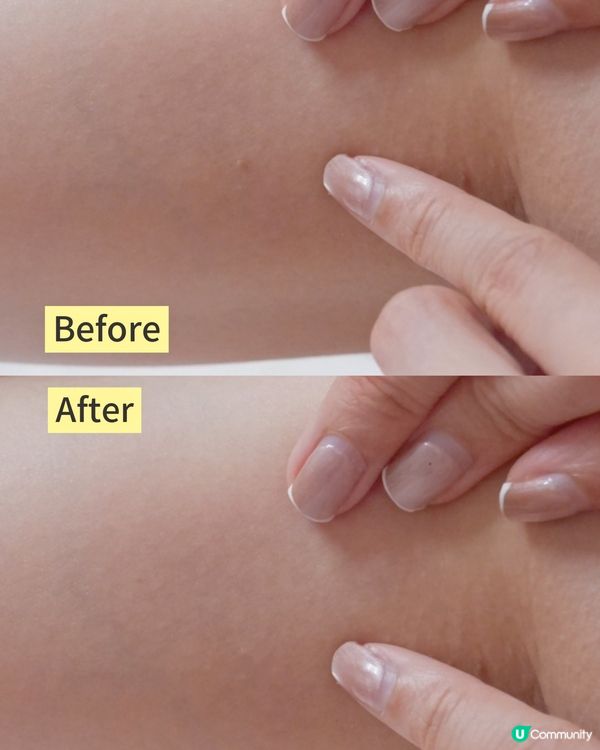 「手腳上的皮膚長起凹凹凸凸的肉粒？有可能是傳染性高的疣！」