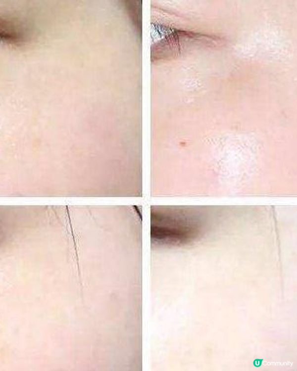 用家用美容機用到起斑？唔怕！有去神器Picolaser皮秒激光去斑！