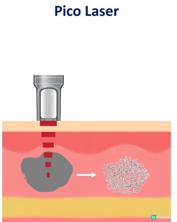 用家用美容機用到起斑？唔怕！有去神器Picolaser皮秒激光去斑！
