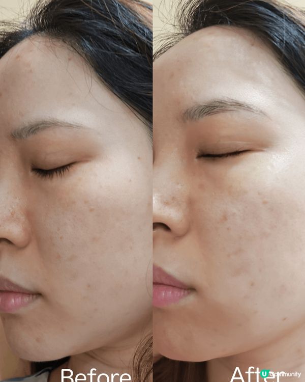 暗瘡印及顴骨的斑非常困擾我，使用了nivea 新出產品LUM...