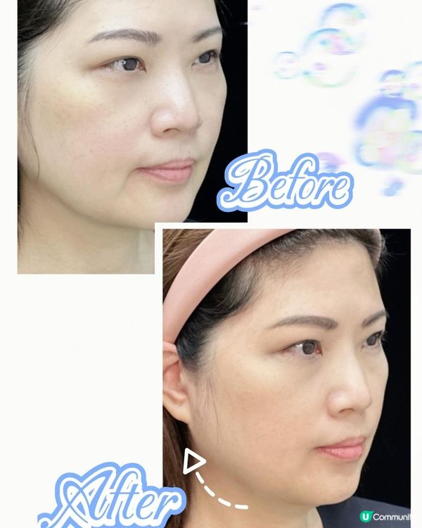 🤍Keep住珍珠肌！LAETIGEN®珠珠針緊緻肌膚淡斑亮白老實測分享✨