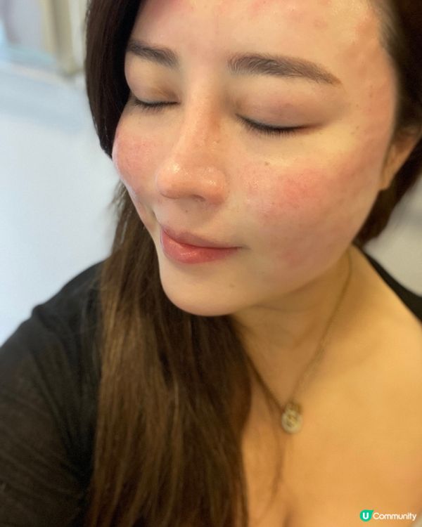 想靜雞雞咁極速變靚💕，珠珠針一定幫到你💦