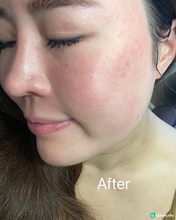 想靜雞雞咁極速變靚💕，珠珠針一定幫到你💦