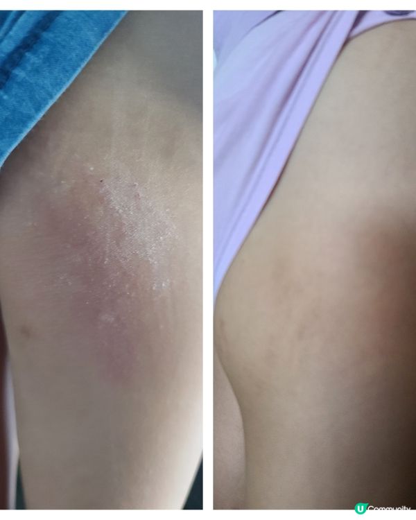 森源鱷敏油 & 足艾貼 