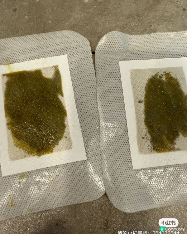 豆豆哥哥濕疹救星！森源鱷敏油+足艾貼🤩 止痕修復超快！