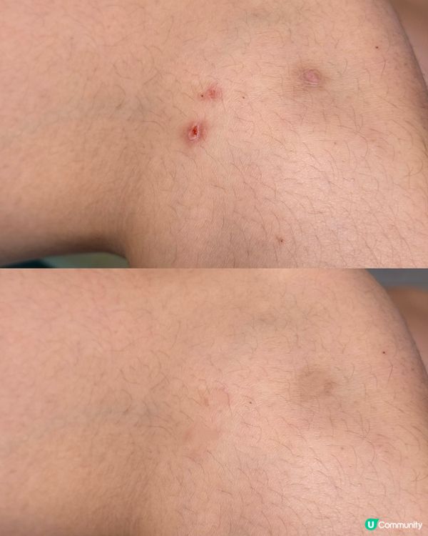 豆豆哥哥濕疹救星！森源鱷敏油+足艾貼🤩 止痕修復超快！