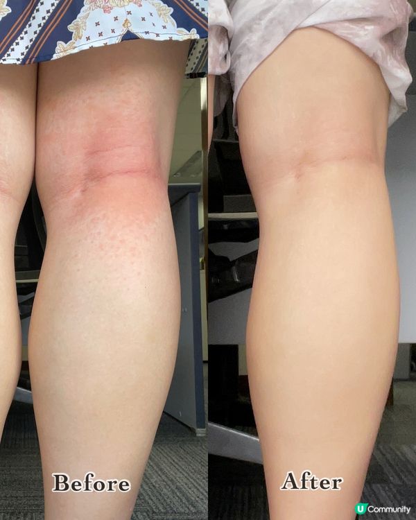 ✨濕疹救星森源鱷敏油✨