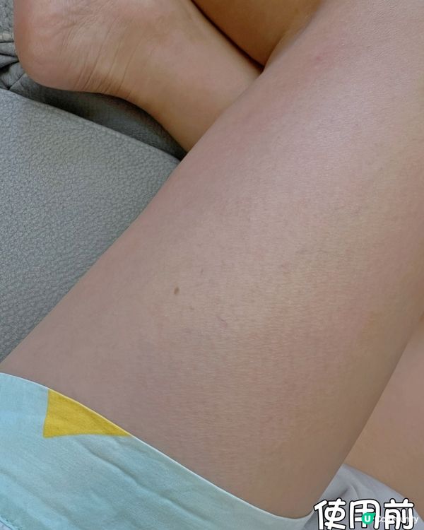 肉粒仔係疣？😱 呢個方法得！ #疣凍寧