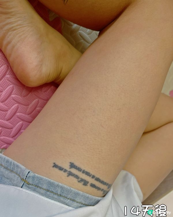 肉粒仔係疣？😱 呢個方法得！ #疣凍寧